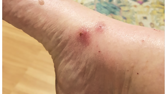 Get tested for Ross River if unwell